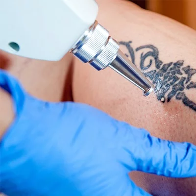 Tattoo Regret? Exploring Your Tattoo Removal Options
