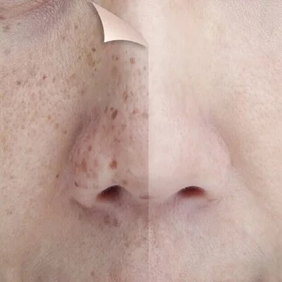 Pico Laser 101: A Comprehensive Guide to the Treatment