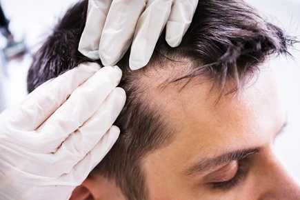 Top Dermatologists for Hair Loss: Expert Recommendations