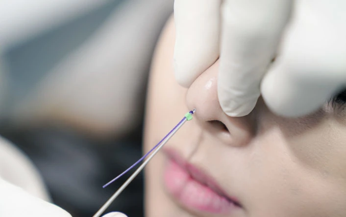 A Non-Surgical Nose Job: Hiko Thread Lift