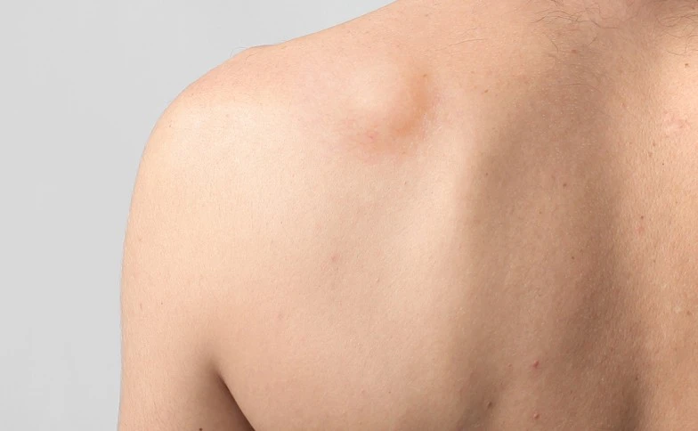 Non-Surgical Approaches to Lipoma Treatment