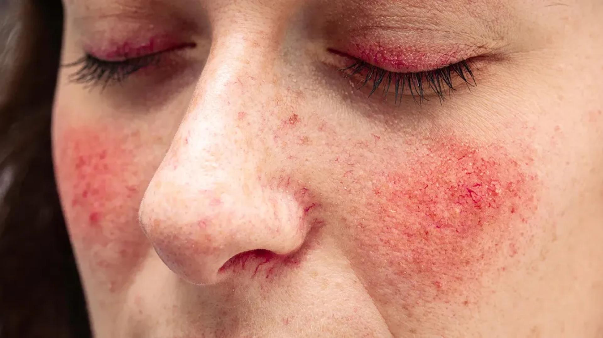 Clear Skin Ahead: Rosacea Treatment Strategies