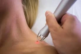 Unveil Radiant Skin: Tips and Tricks for Skin Tag Removal