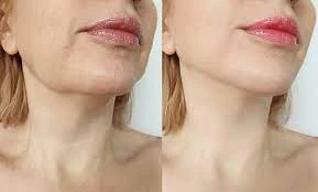 Reshape Your Profile: Chin Liposuction Possibilities