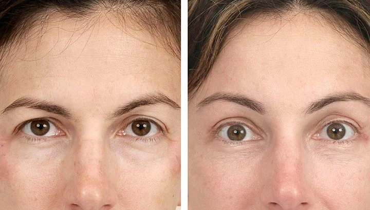 Brow Beauty Revived: The Power of Eyebrow Lift Procedures