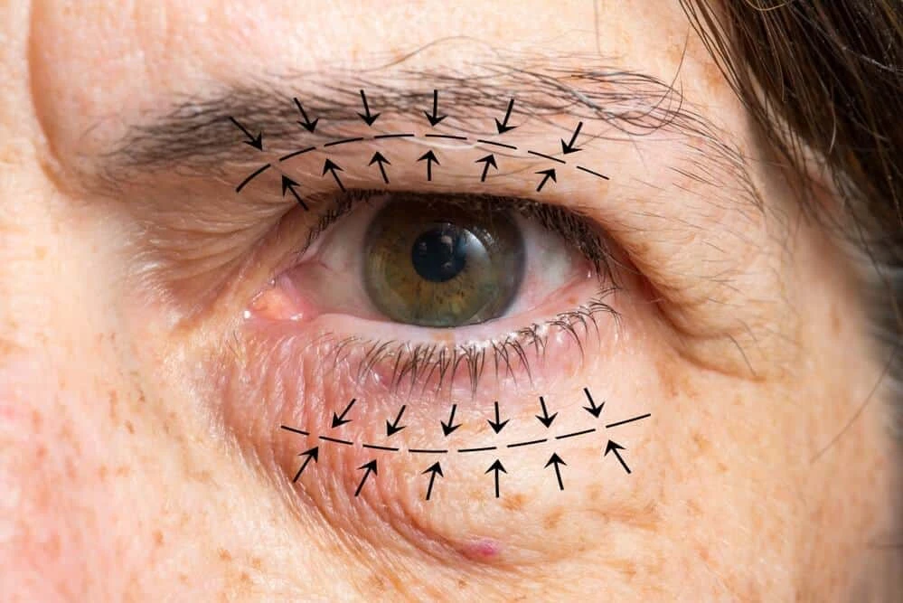 Awaken Your Look: Exploring Eyelid Surgery