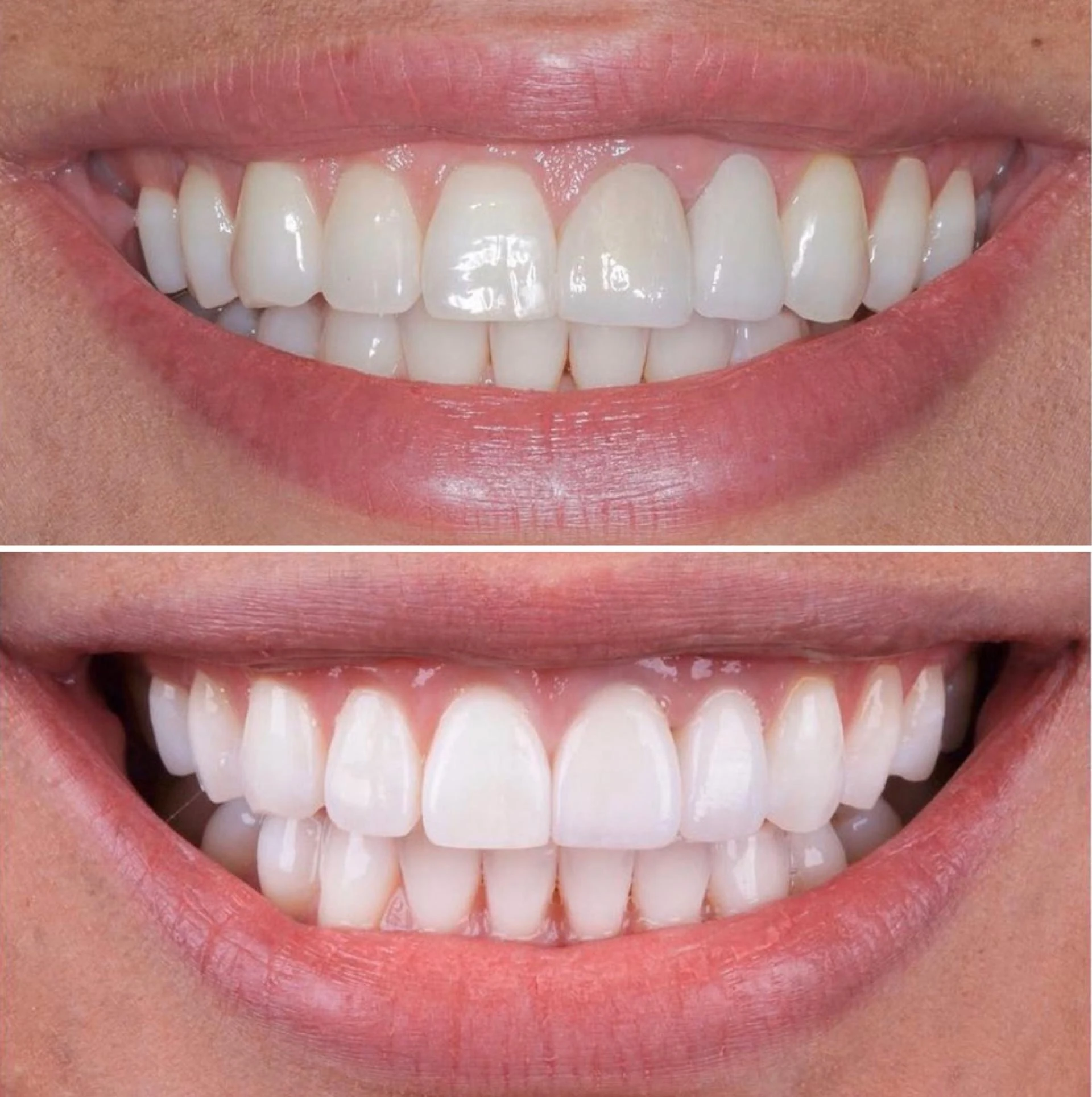 Discover the Magic of E-Max Veneers for Your Teeth