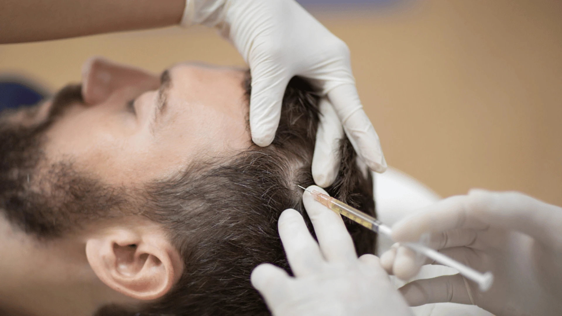 Say Goodbye to Hair Loss with PRP Therapy