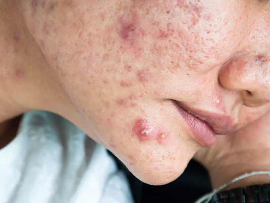 Banish Acne: The Ultimate Guide to Flawless Skin