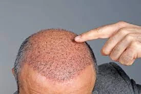 How Hair Transplantation Can Change Your Life