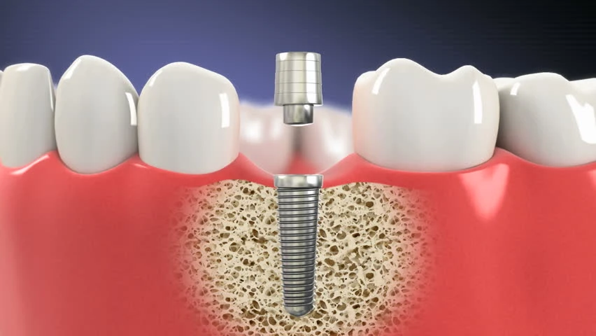 Dental Implants vs. Dentures: Which Option is Right for You?