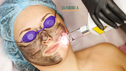 Remove skin blemishes with a Carbon Laser Peel Treatment