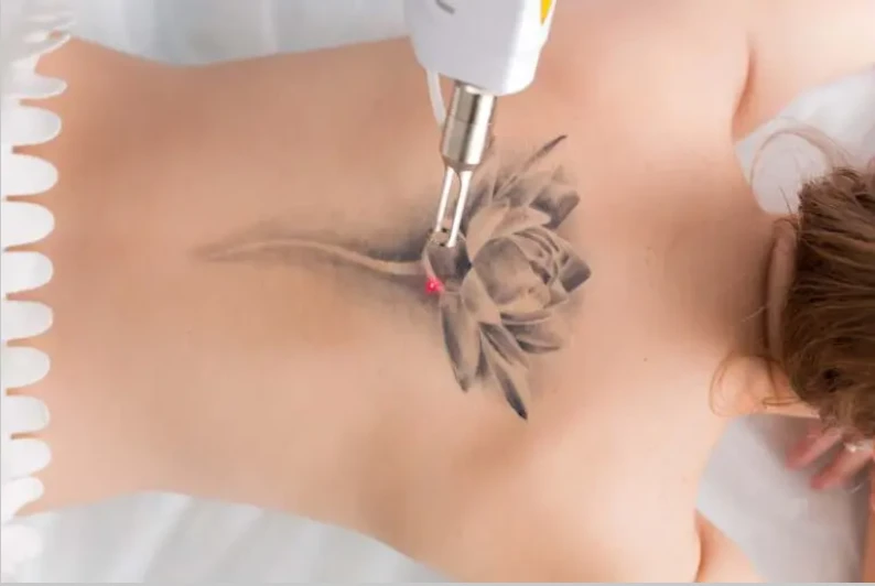 Best Tattoo Removal in Sydney