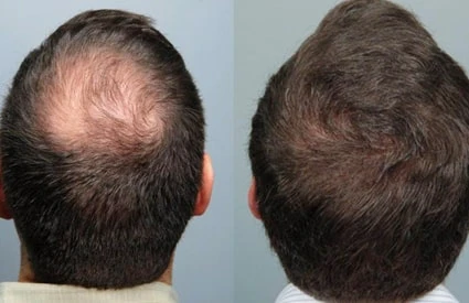 الاستثمار في ثقتك: تحليل تكلفة زراعة الشعر