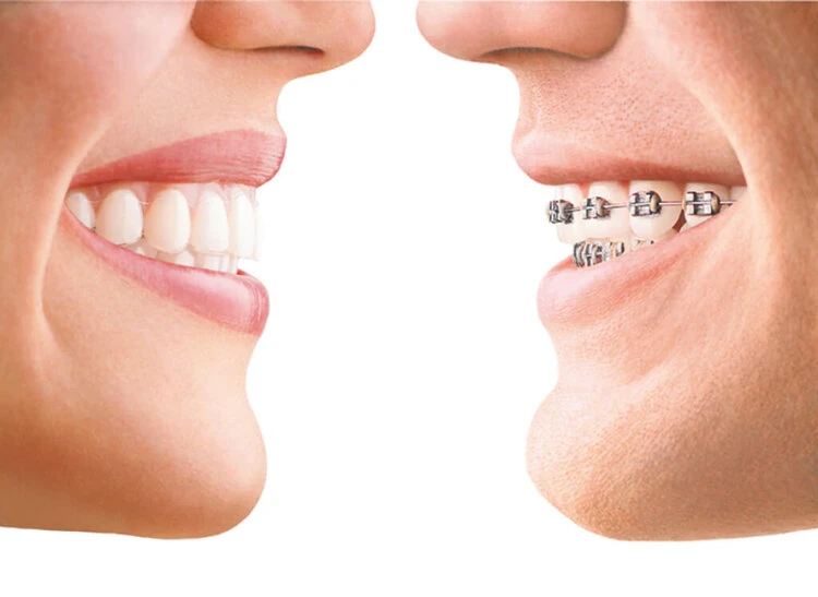 Invisalign vs. metal braces: what's the difference?