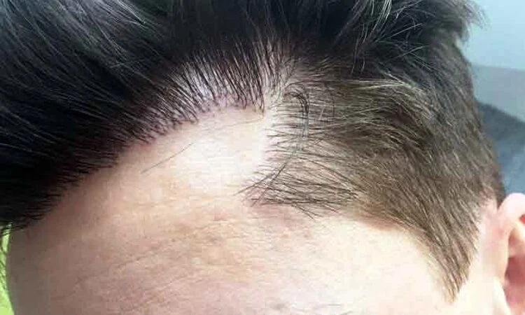 FUE Hair Transplant Procedure in Palm Desert