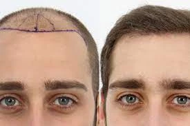 Transplante De Cabello