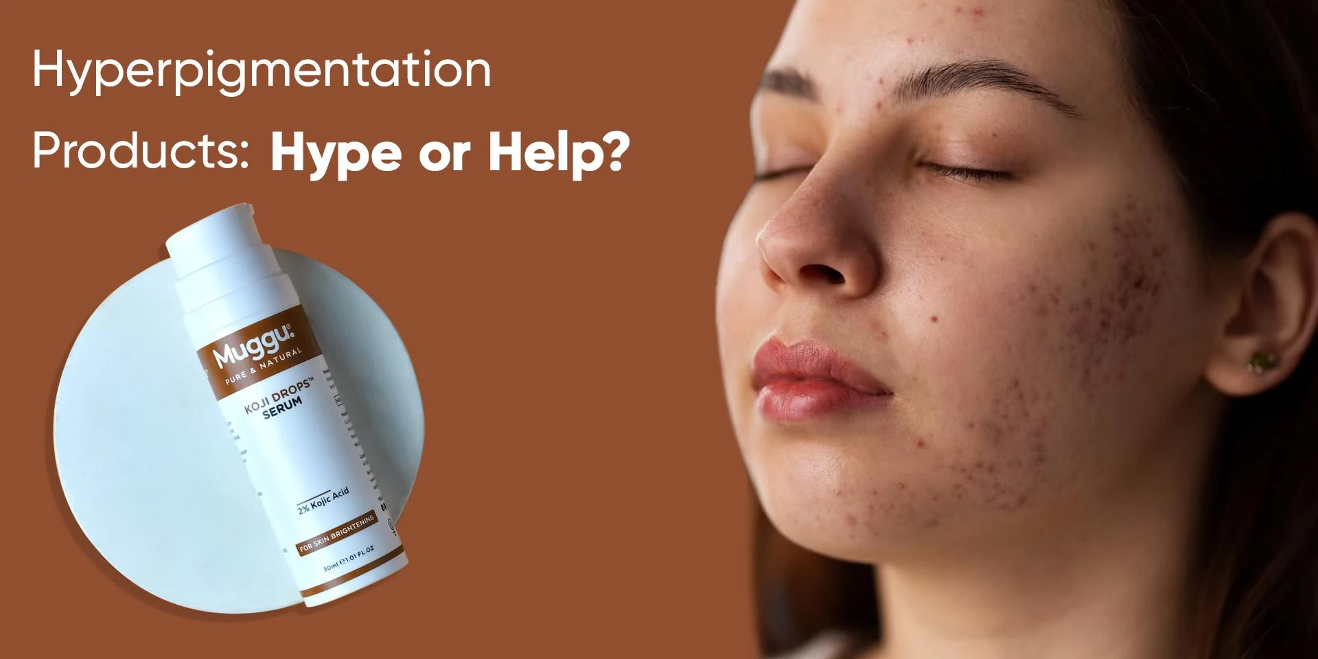 Hyperpigmentation Products: Hype or Help?