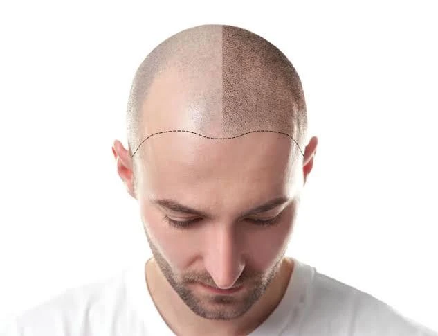 Get To Know The Main Techniques And Importance of Hair Transplant