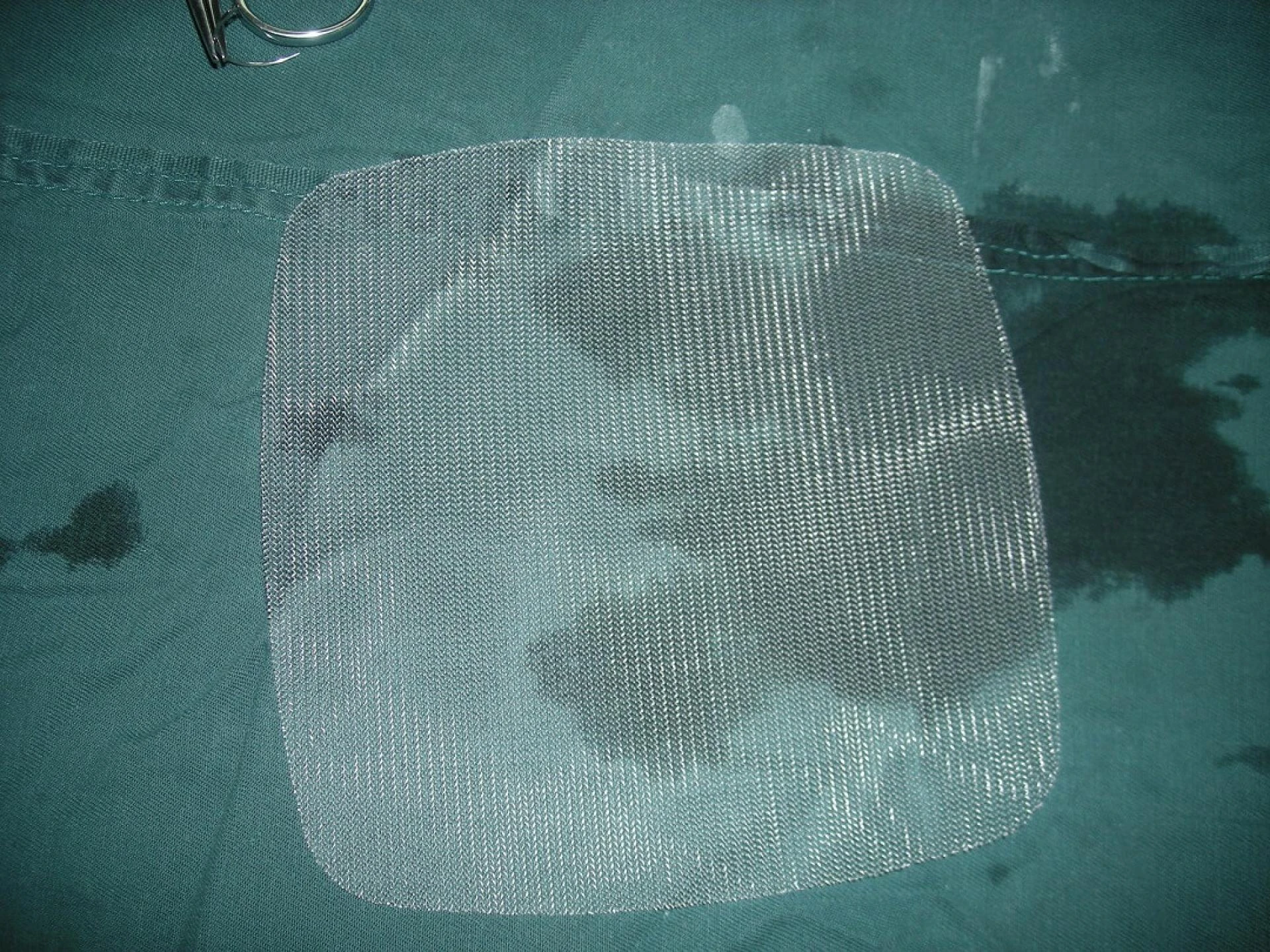 How to Claim for a Defective Hernia Mesh?
