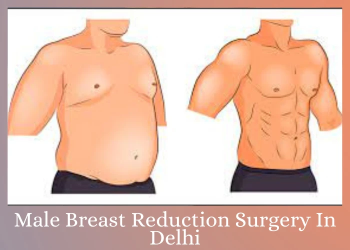 MALE BREAST REDUCTION SURGERY IN DELHI: GET RID OF EXCESS BREAST TISSUE SAFELY AND EFFECTIVELY