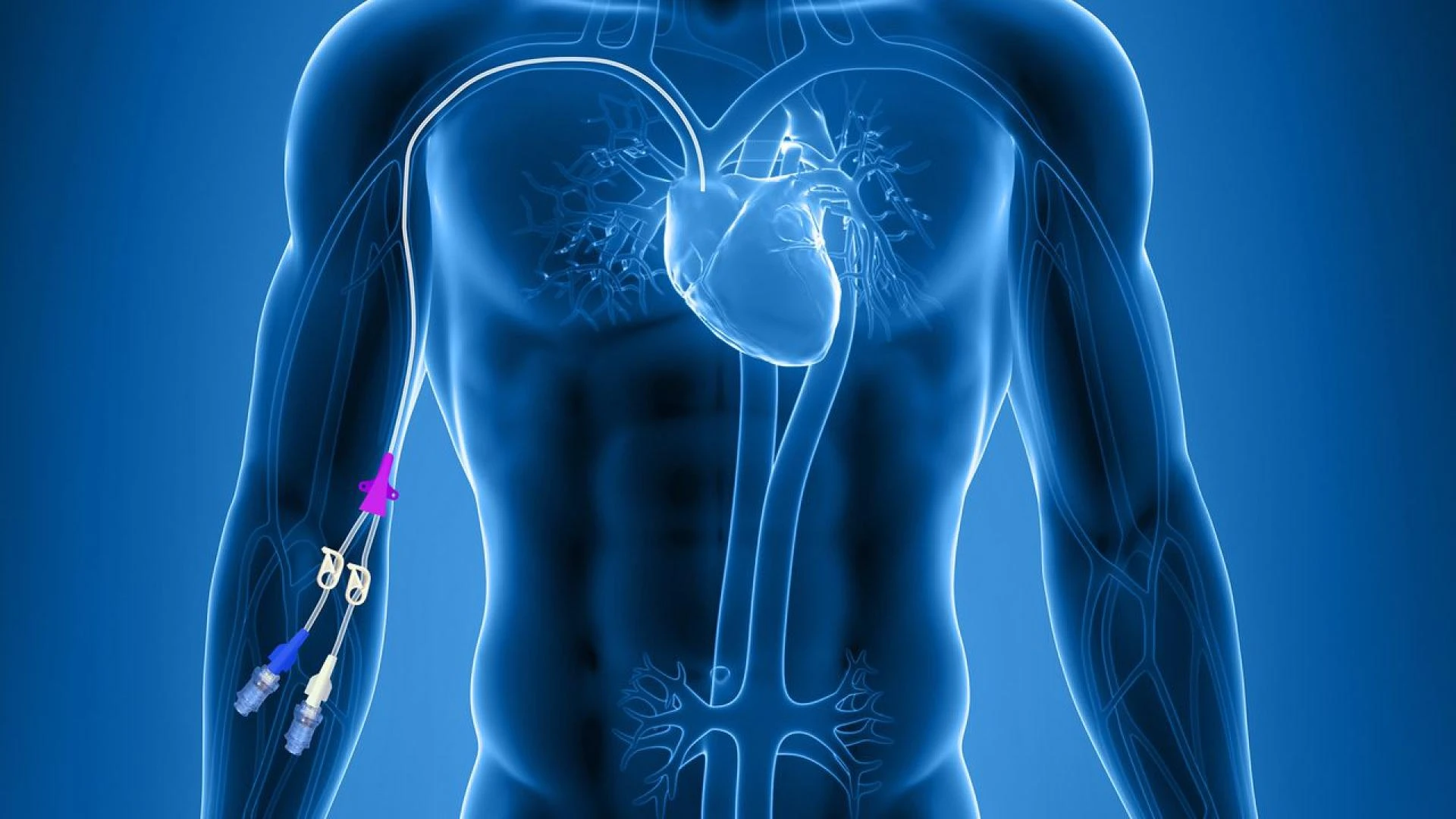 To gain central access via peripheral veins, the tip of a peripherally implanted central catheter is