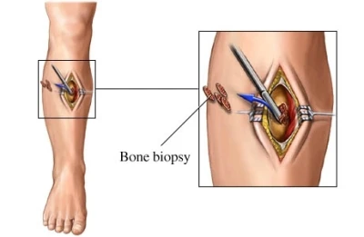 The rising incidence of cancer and tumours is driving the demand for sarcoma biopsy