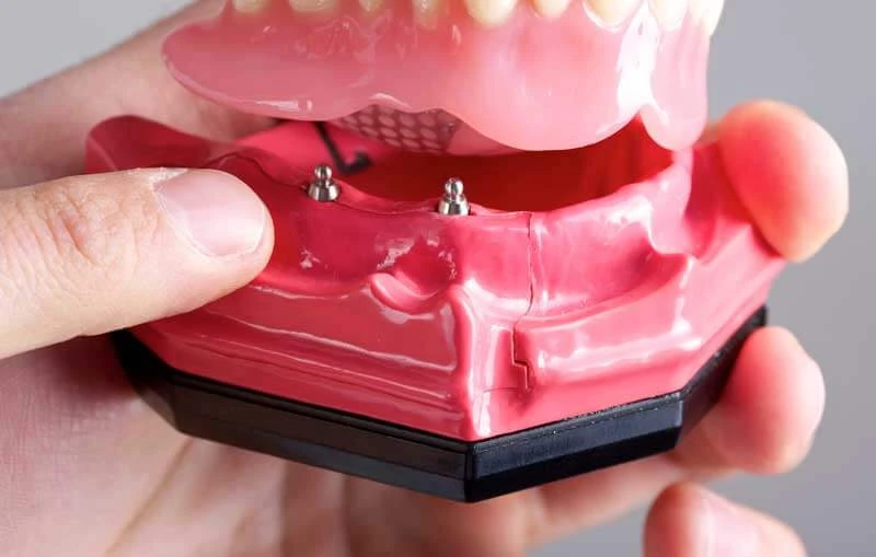 Choosing the Right Dentist for Mini Implant Dentures