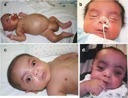 Stem cell technology is emerging as one of the Mucopolysaccharidosis (MPS) treatment