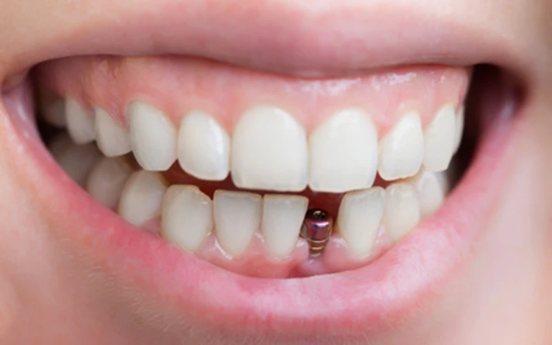 Dental Implants Offer a Permanent Solution for Missing Teeth