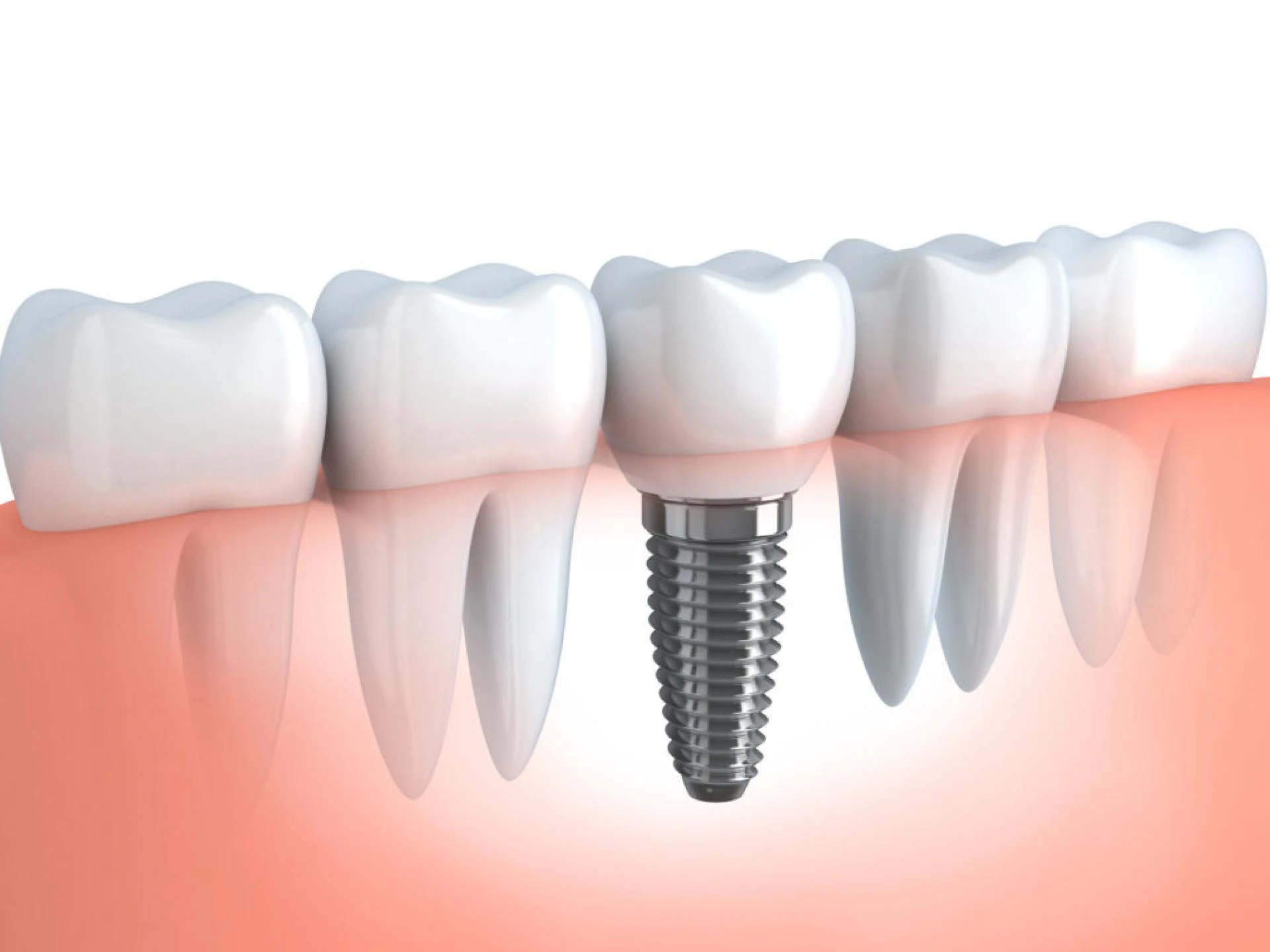 Have You Tried Single Implant Monroe LA?