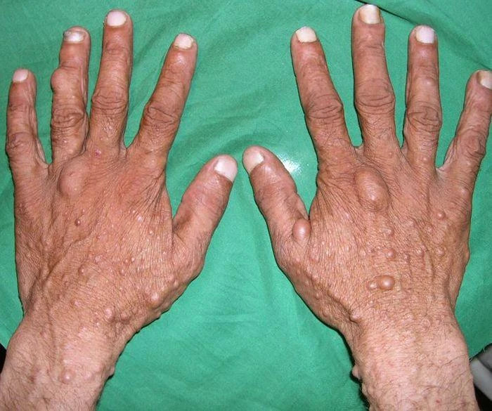 With millions of people suffering from neurofibromatosis, the demand for efficient neurofibromatosis