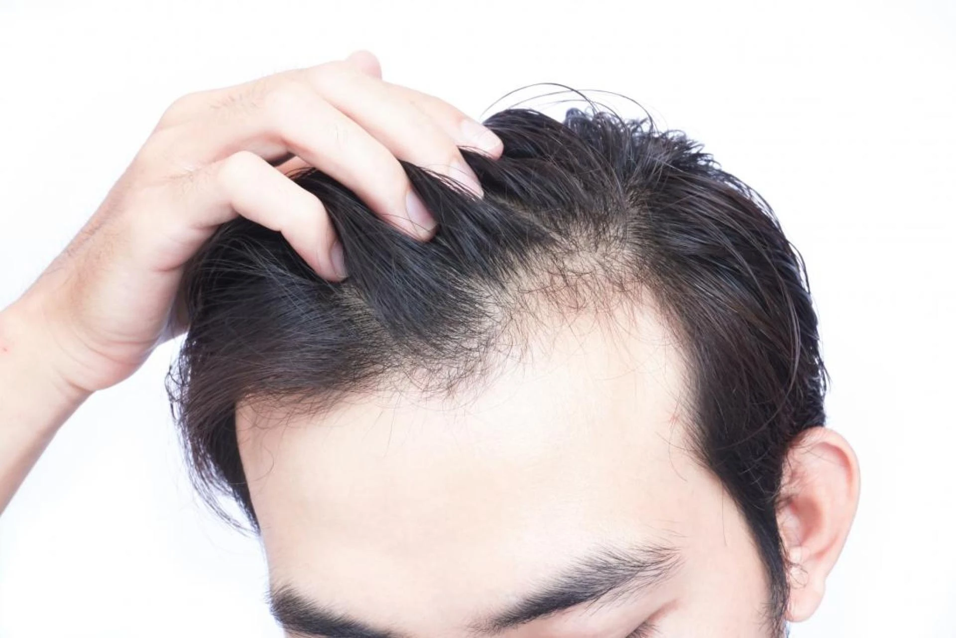 Are Hair Transplants Effective?