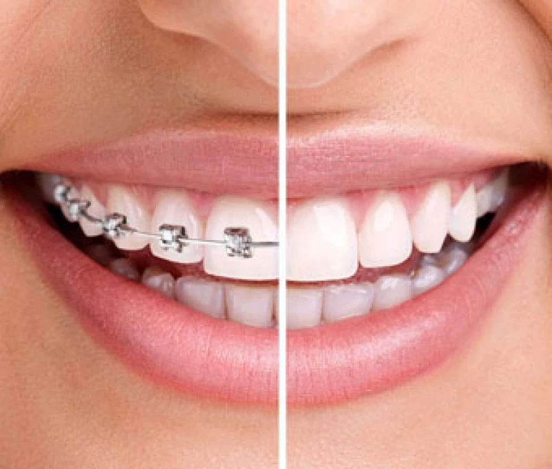 Getting Ready for Invisalign: 5 Must-Know Tips Before You Begin