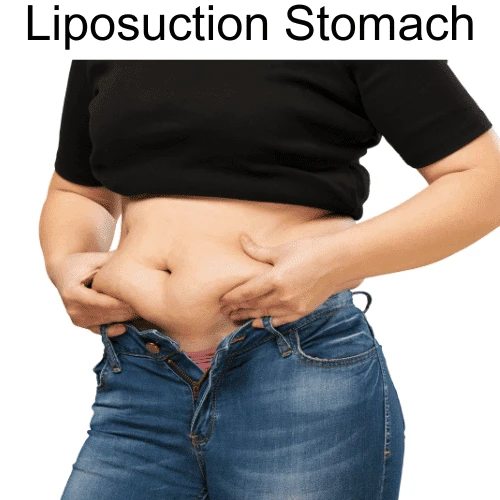 10 Liposuction Health Benefits You Want To Know About: A blog about liposuction health benefits and risks