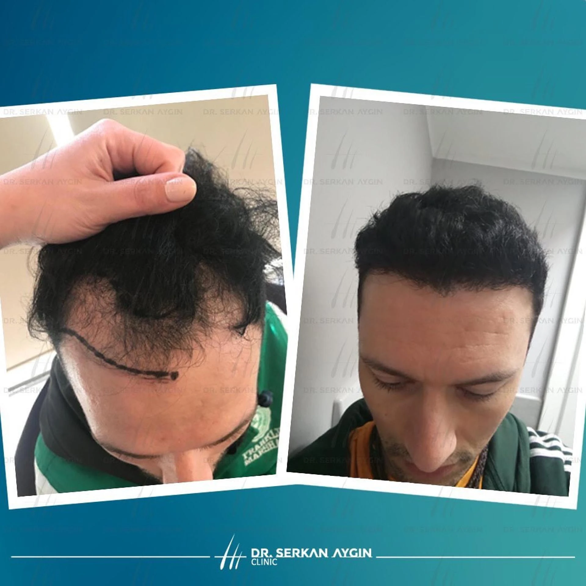 Dr. Serkan Aygin Clinic Reviews - DHI Hair Transplant Without Shaving