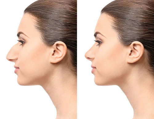 What’s Rhinoplasty? Here’s Everything You Need to Know