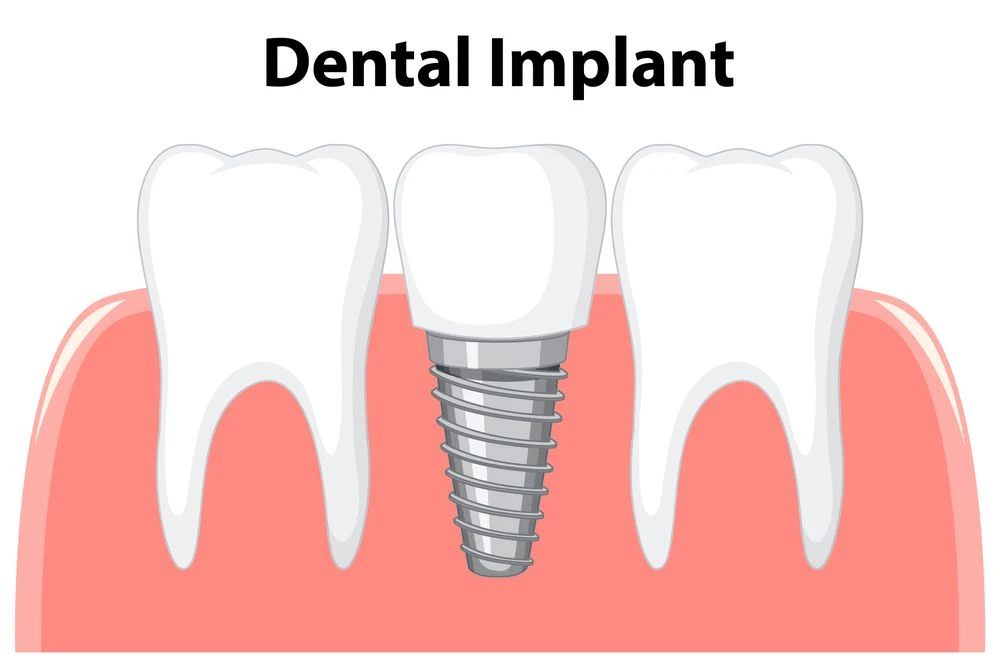 Top 7 Benefits of Dental Implants for Oral Health