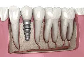 what is Dental Implant treatment