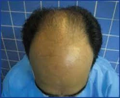 غير مظهرك مع زراعة الشعر التاجي