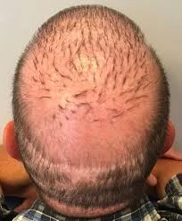 إجراء علاج زراعة شعر اللحية