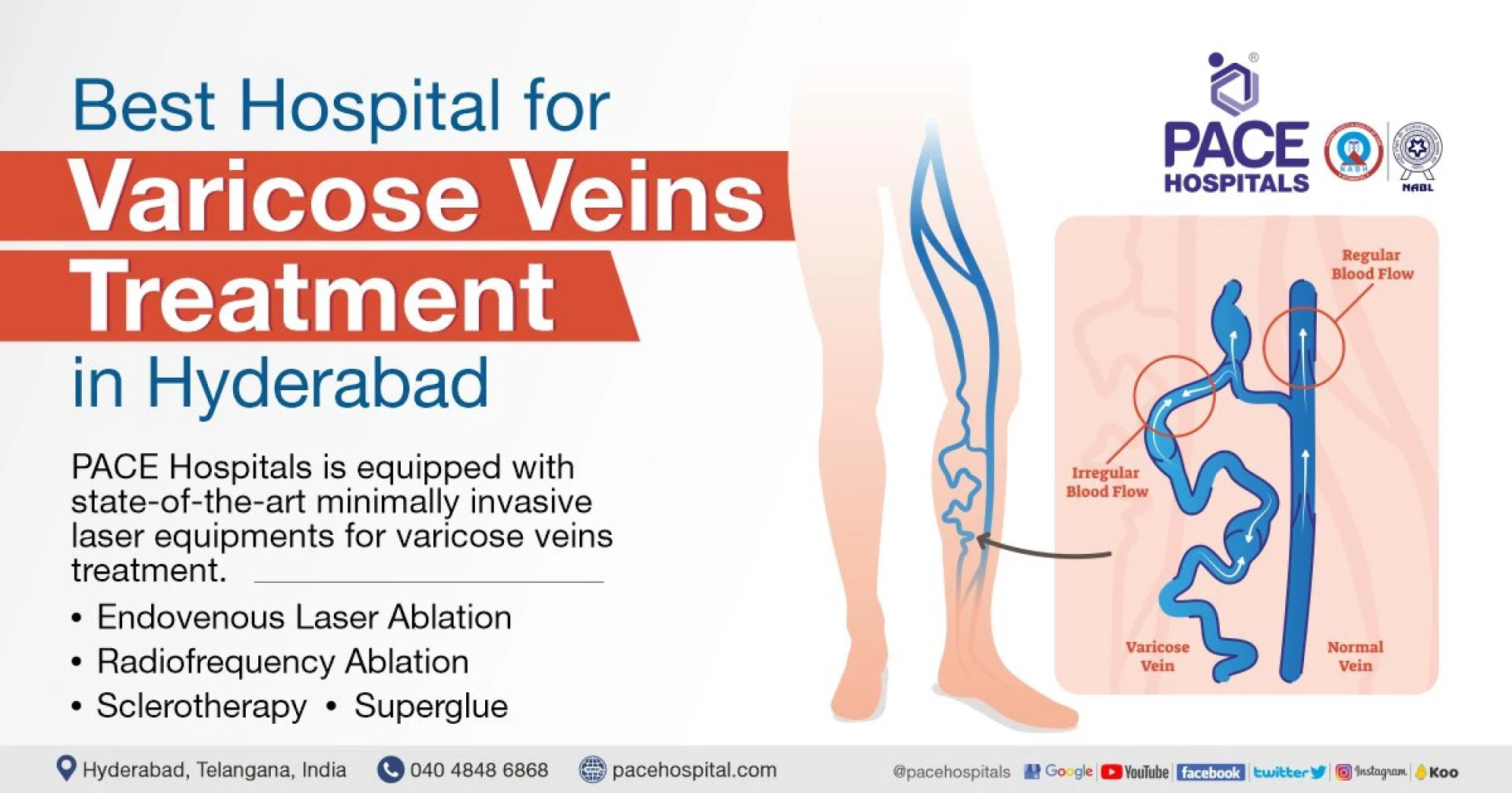 Varicose Veins Treatment in Hyderabad - Painless and Effective Minimally Invasive Treatment
