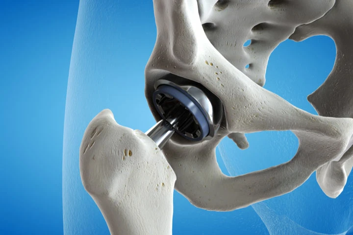 Bone Replacement Market Massive Segments; Investors Seeking Growth | Colfax Corporatio, Exactech Inc, Smith &amp; Nephew Plc.