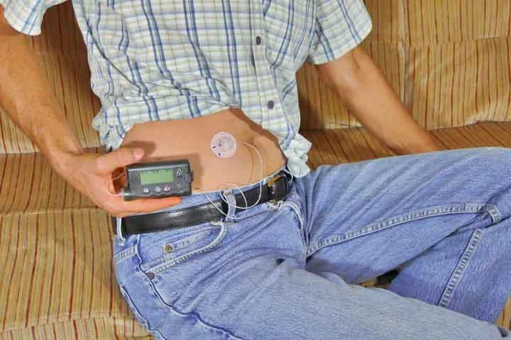 Tubeless Insulin Pump Market to Garner $2,837.6 million by 2031: Research Dive