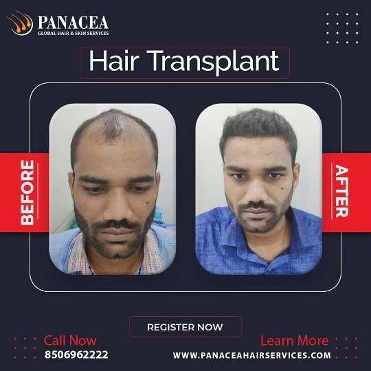 Best Hair Transplant In Delhi NCR, India