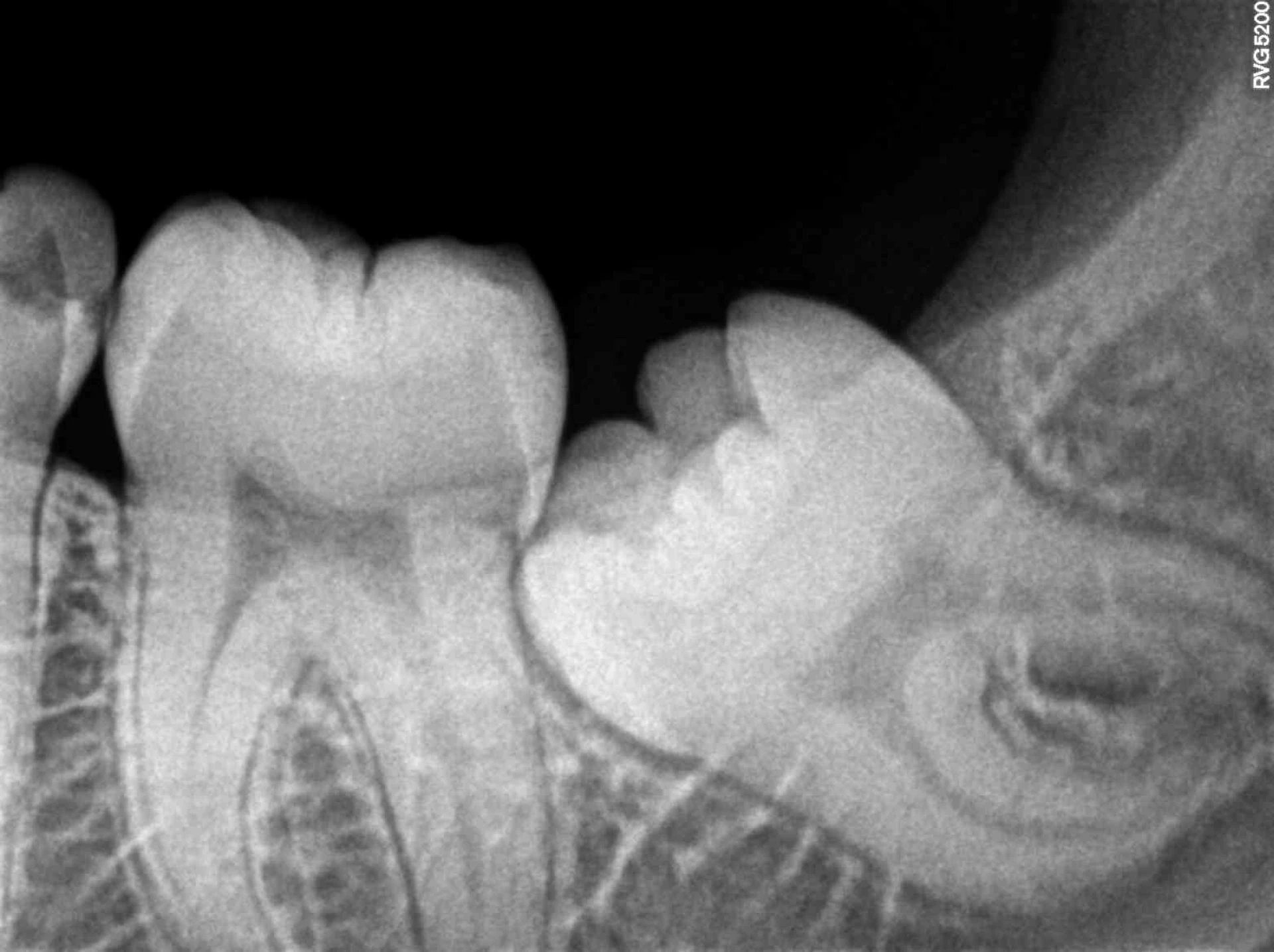 Symptoms And Causes Of Impacted Wisdom Teeth