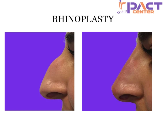 Are you looking for rhinoplasty surgery in Delhi?
