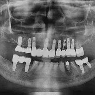Steps of Dental Implants | Dental Clinic in Mohali | Dental Excellence