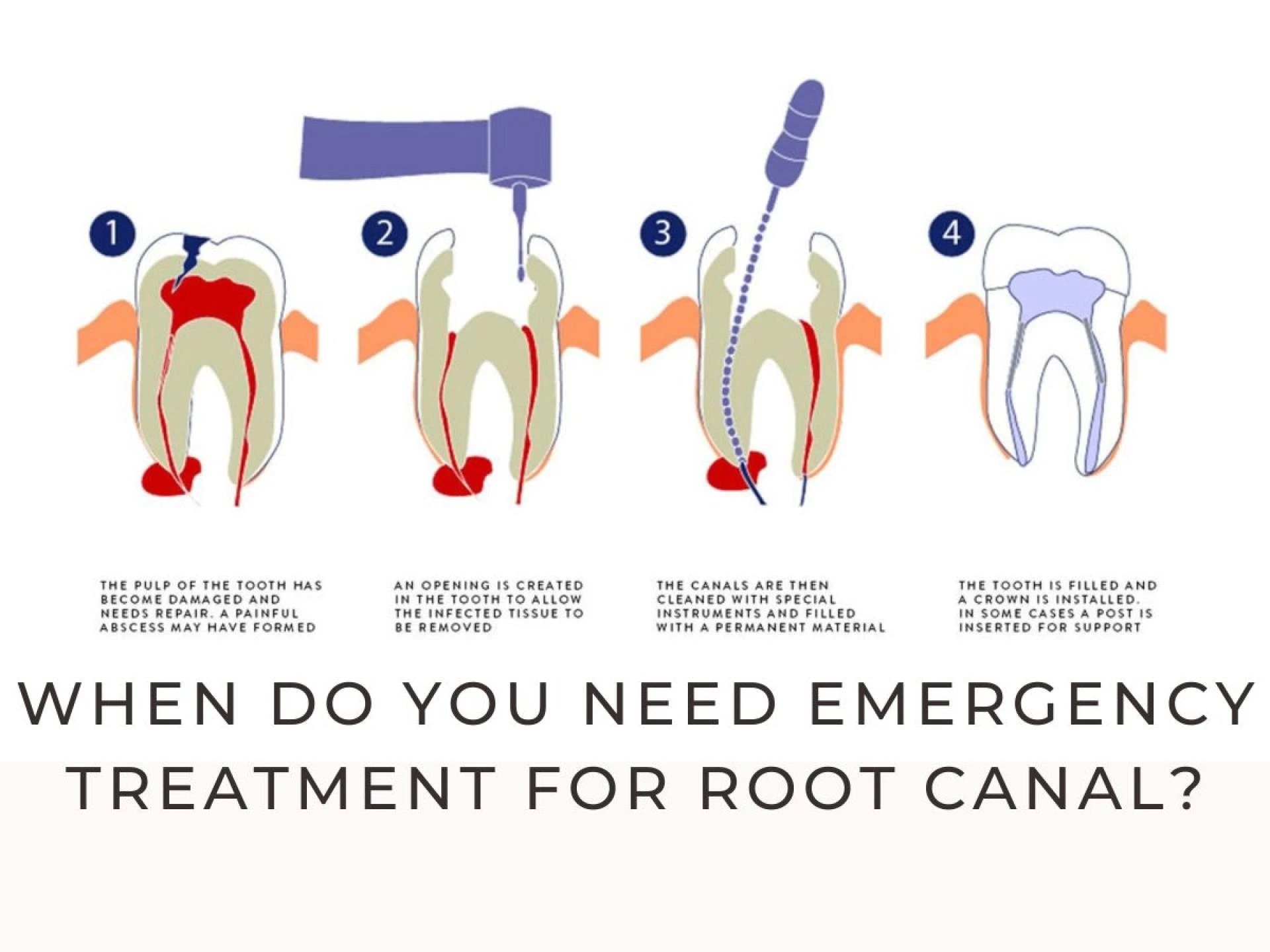 Need For Root Canal Treatment