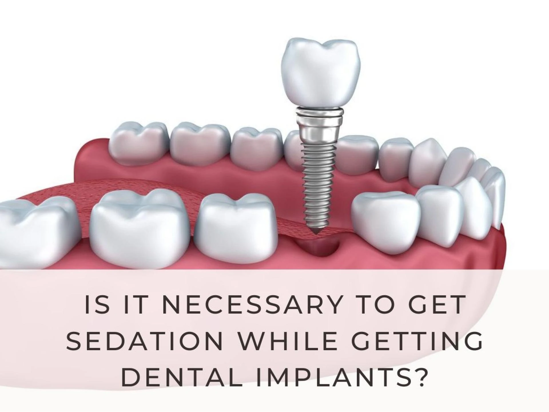 Is It Necessary To Get Sedation While Getting Dental Implants?
